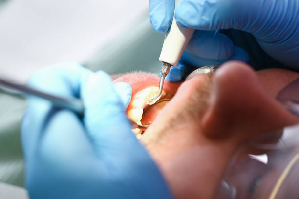Best Root Canal Emergency Dentist  in Harsville, RI